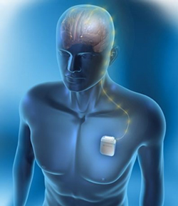 A neurostimulation device being used for deep brain stimulation