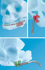 Craniomaxillofacial Distraction System components shown in x-ray