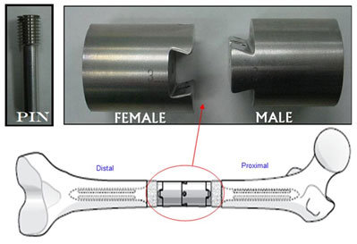 Limb Preservation System and how it attaches to the bone