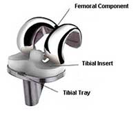 Reclassification of hip, knee and shoulder joint replacement implants ...