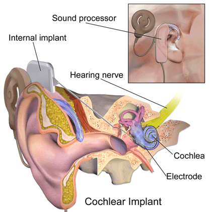 Image of cochlear implant