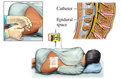 Figure 1: Placement of epidural catheters - The catheter comes into close contact with nerve tissue.